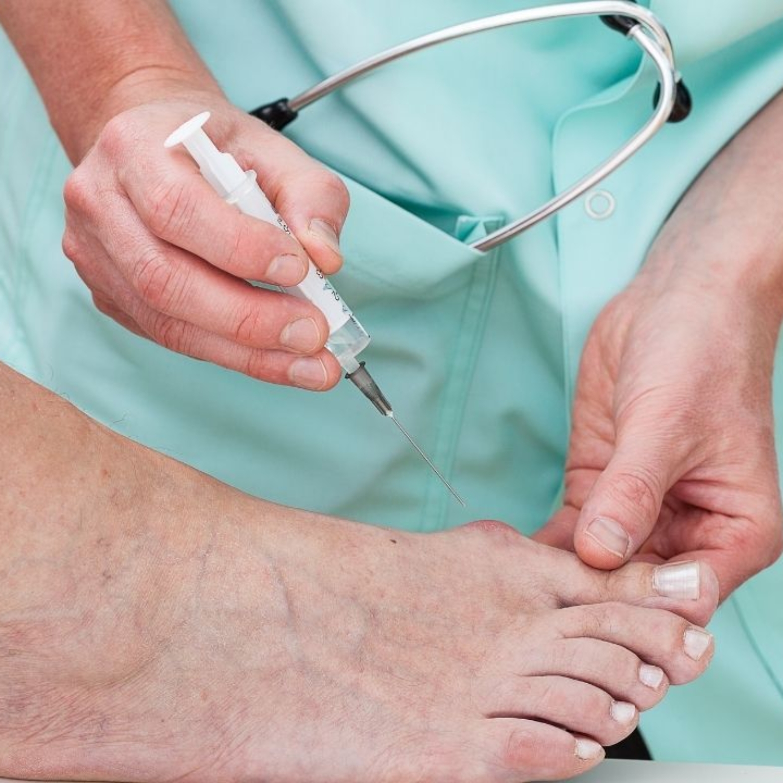 Understanding Bunion Treatment: Exploring the Right Time for Surgery