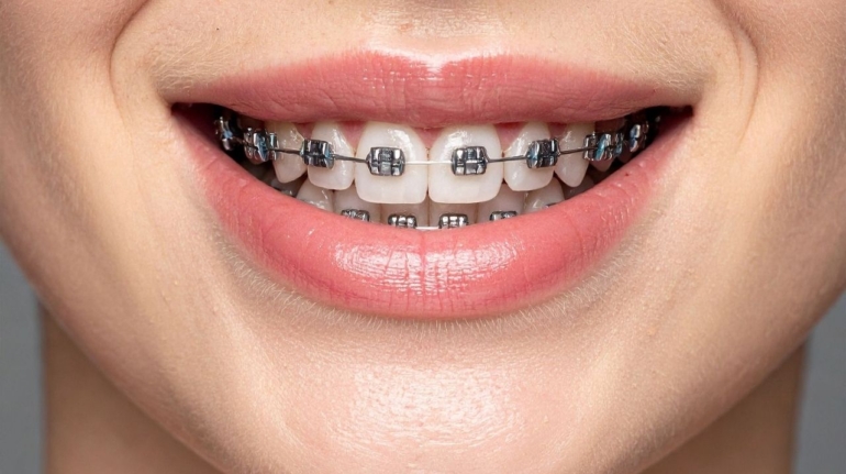 Ortodoncja dla dorosłych i dzieci — jakie są nowoczesne metody prostowania zębów?