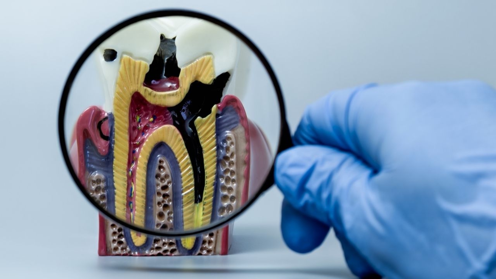 Leczenie kanałowe pod mikroskopem – kiedy jest konieczne